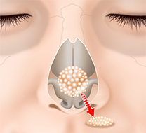 鼻先の皮下脂肪を切除