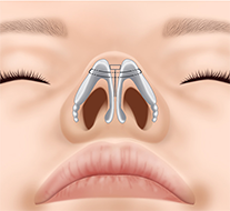 鼻翼軟骨を糸で寄せ、鼻先の形態を整えます。
