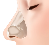 採取した鼻中隔軟骨や肋軟骨を移植し方向を調整します。