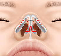 ＜オープン法＞プロテーゼに鼻尖形成や鼻中隔延長も行う場合