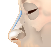 術前に予定した高さの鼻プロテーゼを骨膜下に挿入します