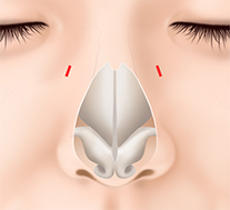 鼻骨と外側鼻軟骨の突出をノミで削ります。同時に鼻骨骨切りを行う場合もあります